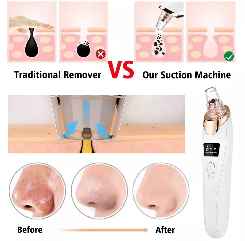 5-in-1 Blackhead Remover